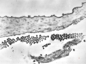 F, 39y. | collagenous and elastin fibers from corium